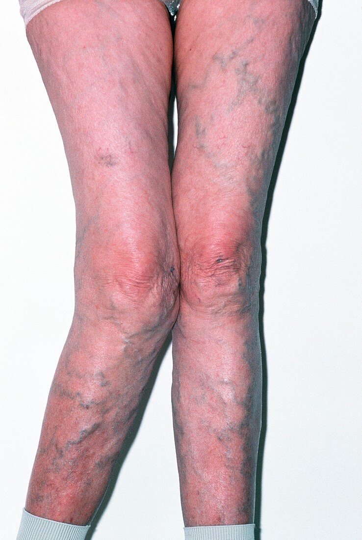 Osteoarthritis in the right knee in a woman