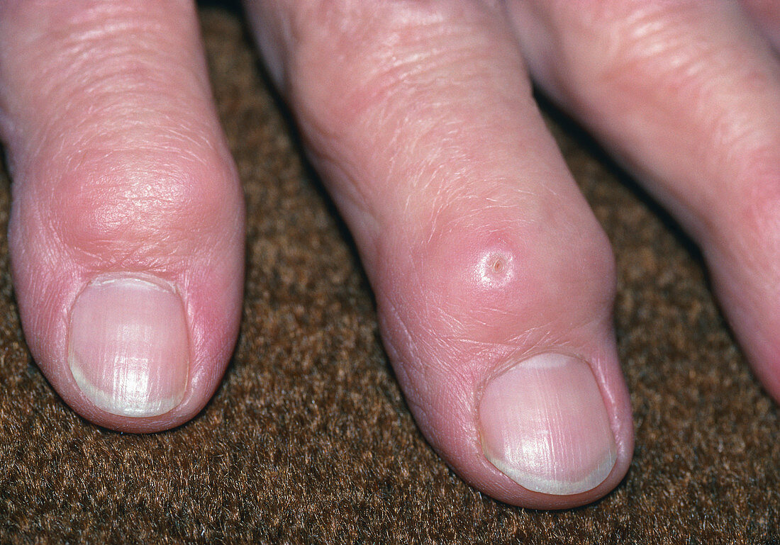 Deformed fingers due to rheumatoid arthritis