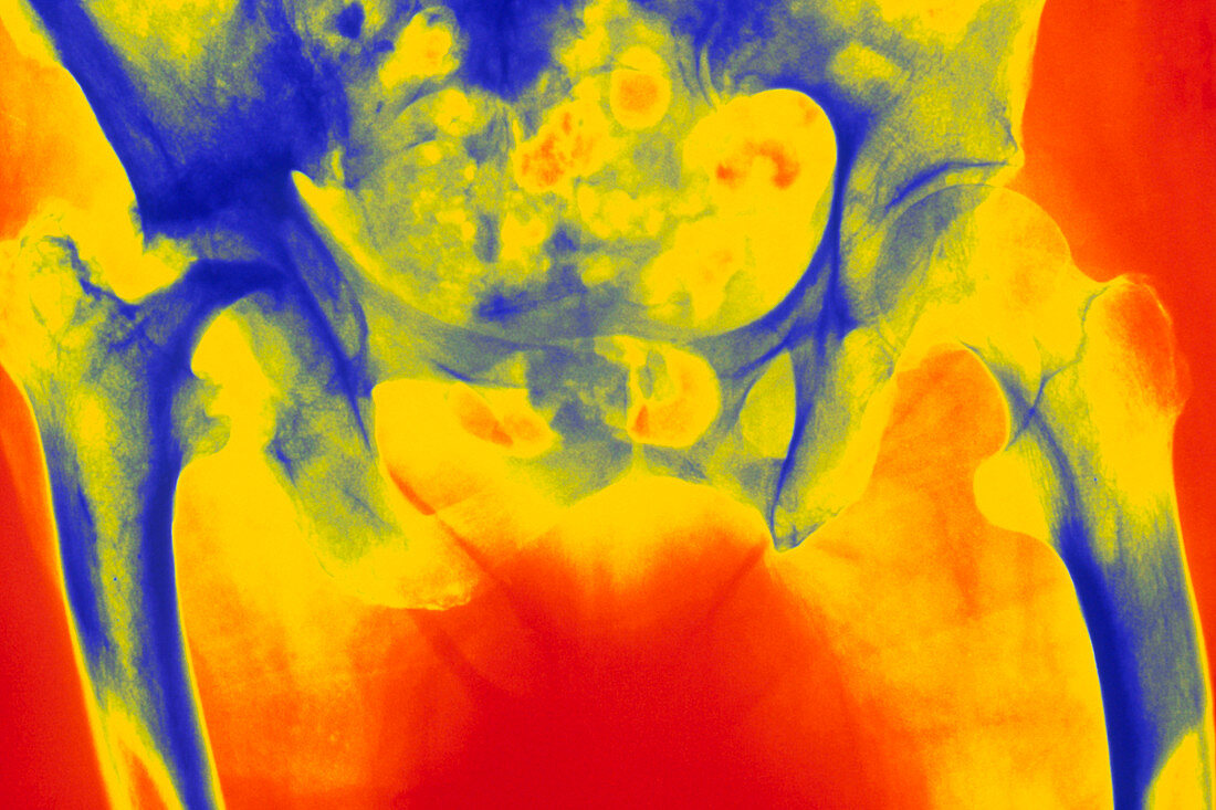 Coloured X-ray of osteoarthritis of the hip
