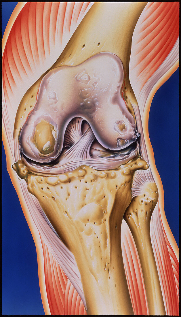 Osteoarthritic knee