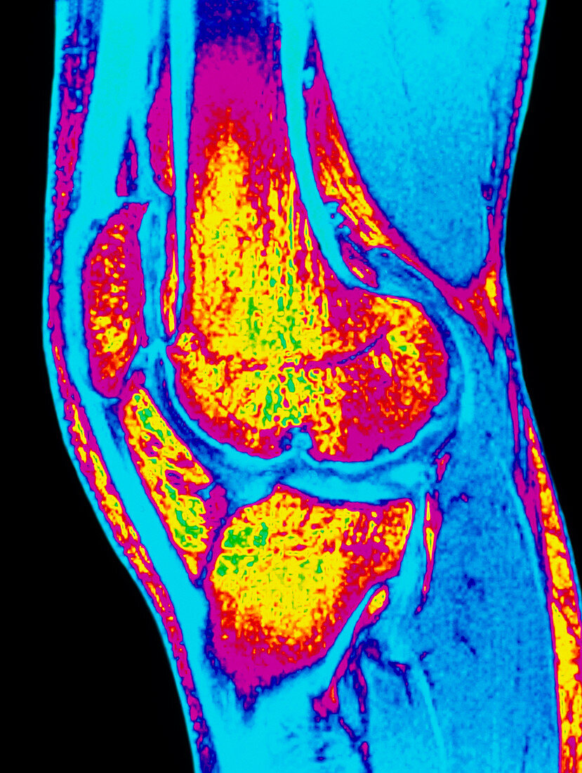 Colour MRI scan of knee joint with osteoarthritis