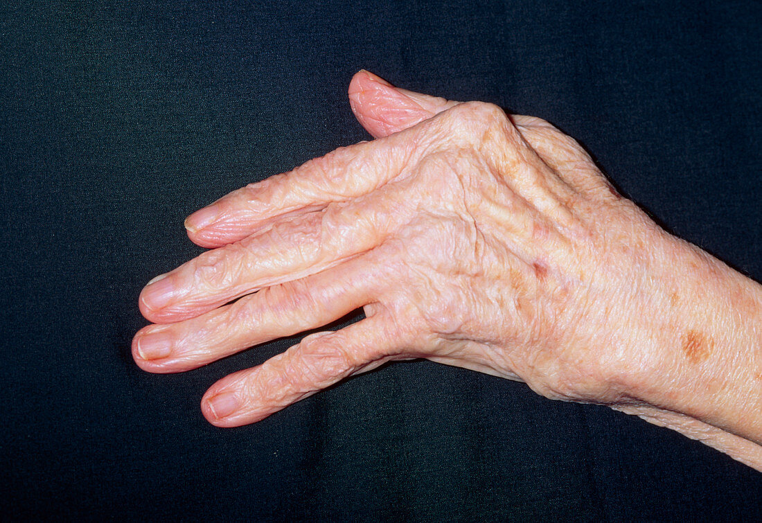 Hand of elderly woman with rheumatoid arthritis