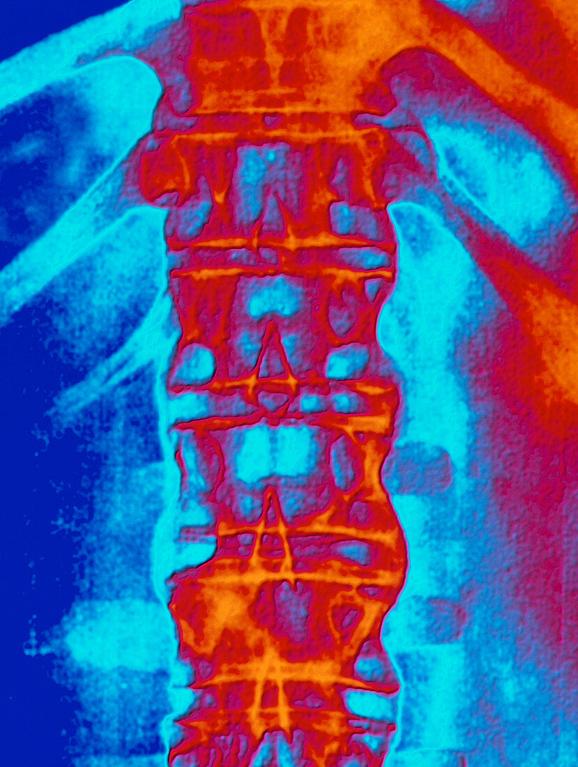 Coloured spinal X-ray: ankylosing spondylitis