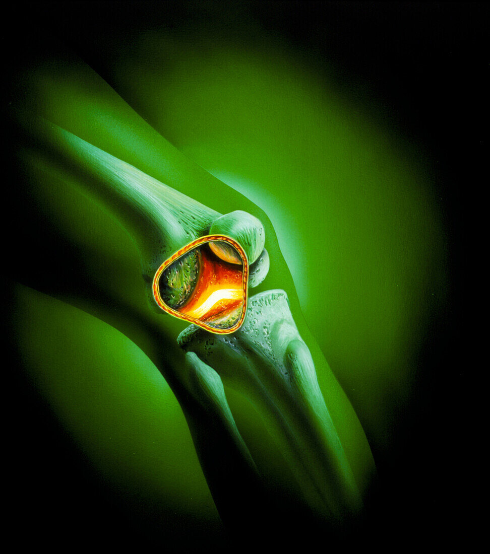 Artwork showing arthritis of the knee joint