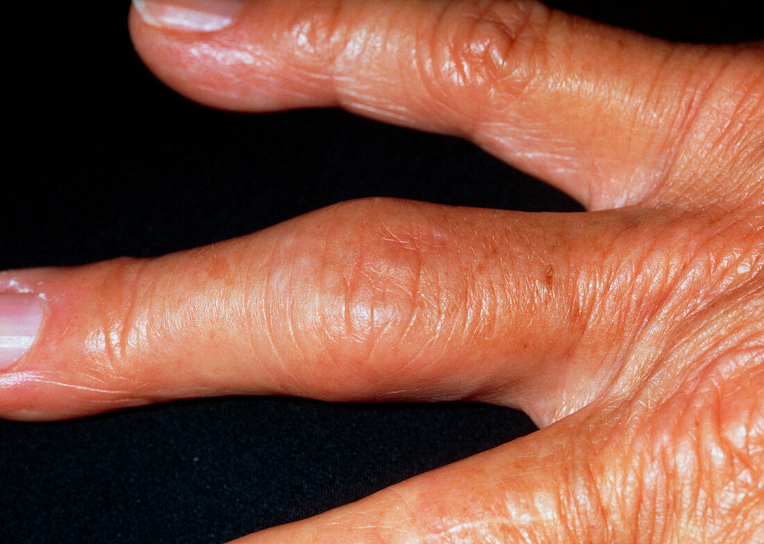 Hand showing fingers affected by osteoarthritis