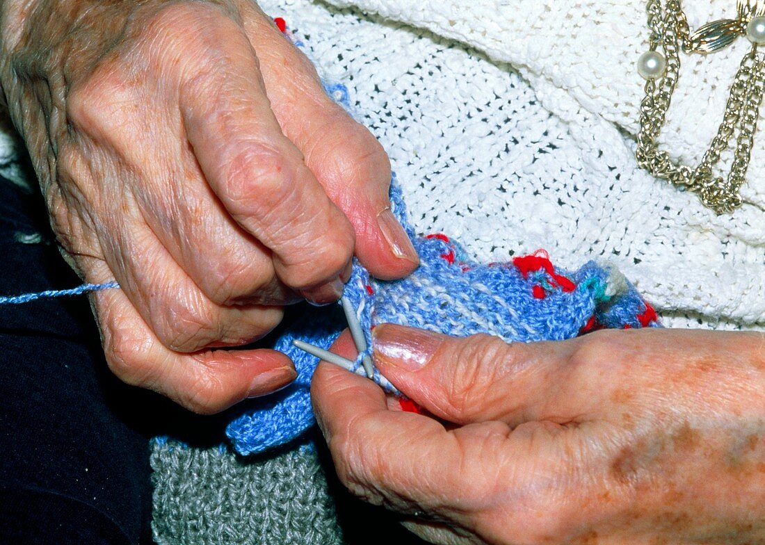 Hands knitting affected by osteoarthritis