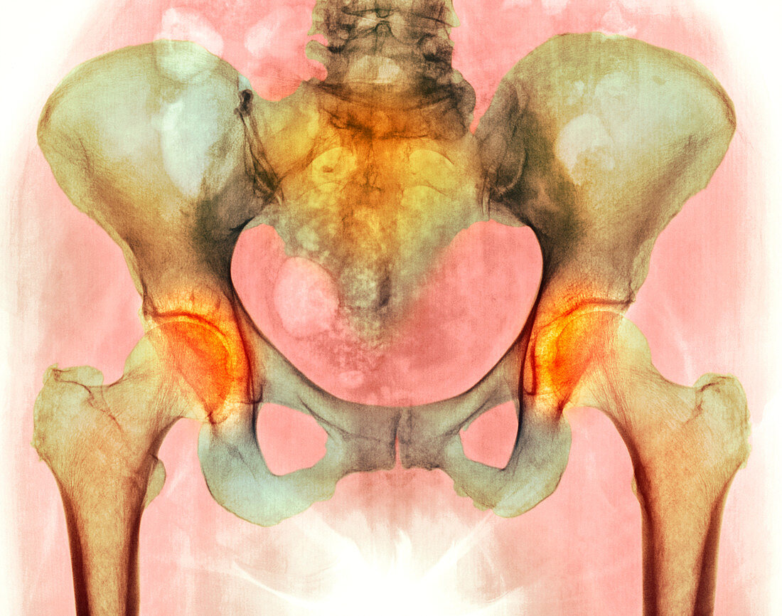 Osteoarthritis of hip joints,X-ray