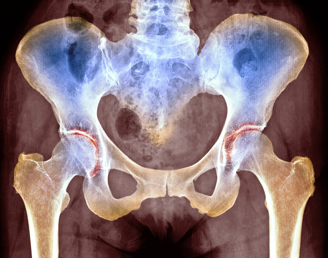 Osteoarthritis of hip joints,X-ray