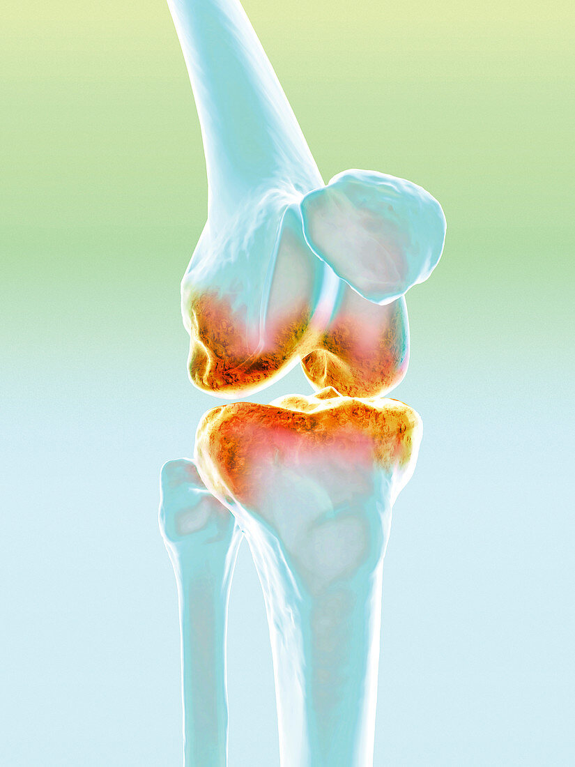 Arthritic knee,computer artwork