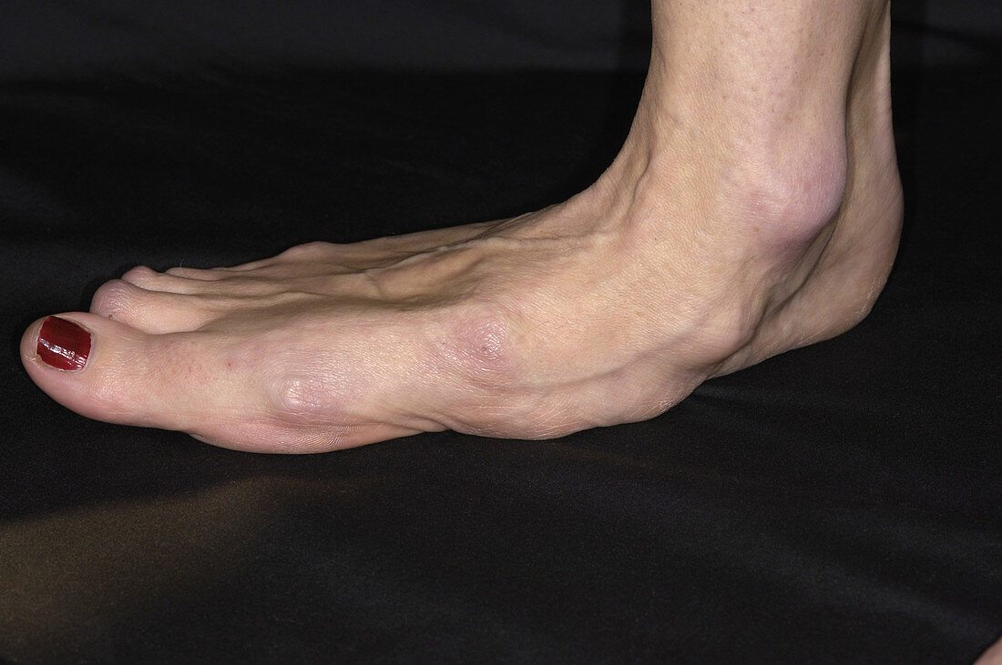 Arthritic foot
