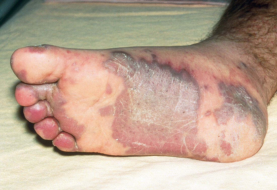 Kaposi's sarcoma on the foot of an AIDS patient