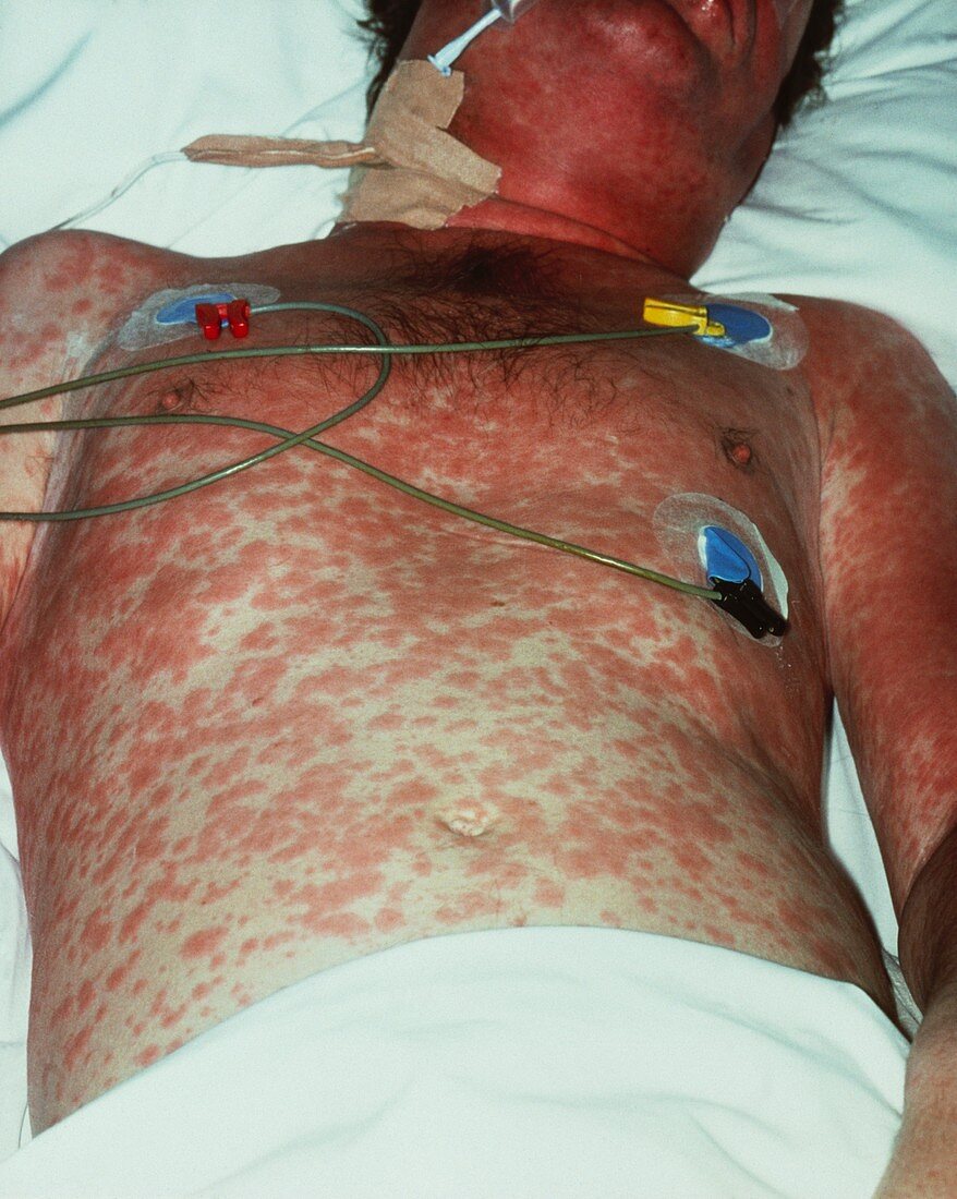 AIDS patient suffering from Pneumocystis carinii