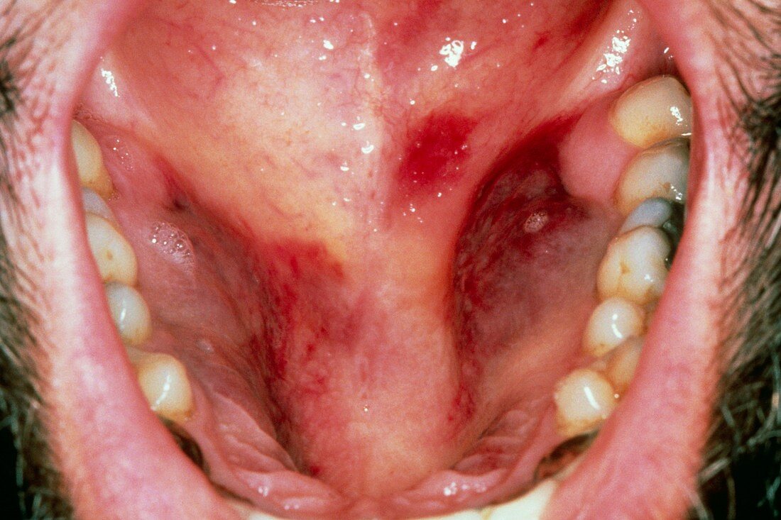 Kaposi's sarcoma in the mouth of an AIDS patient