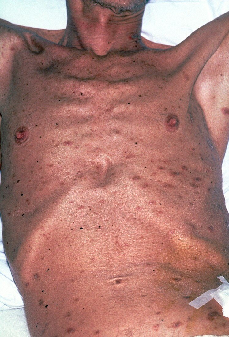 Seborrhoeic dermatitis & emaciation in AIDS