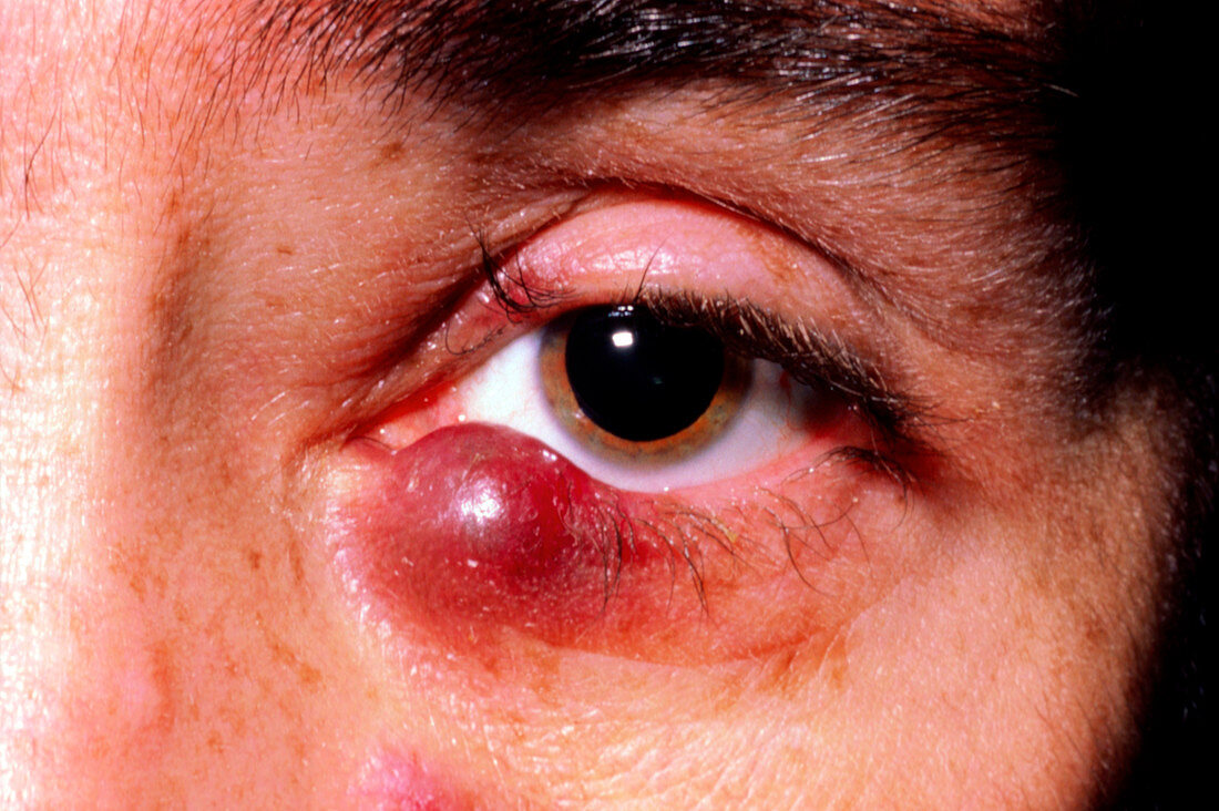 Kaposi's sarcoma on lower eyelid of man with AIDS