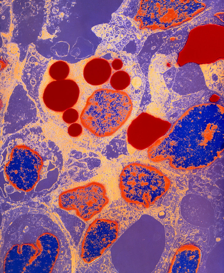 Coloured TEM of Kaposi's sarcoma a skin cancer