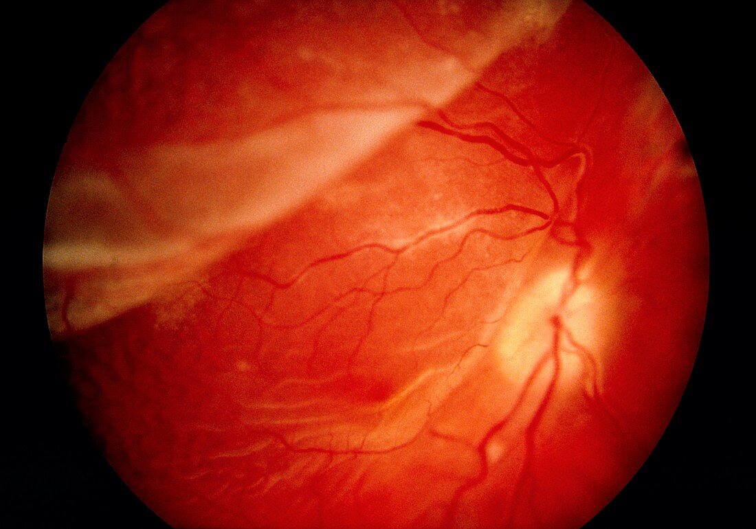 Ophthalmoscopy of detached retina in AIDS patient