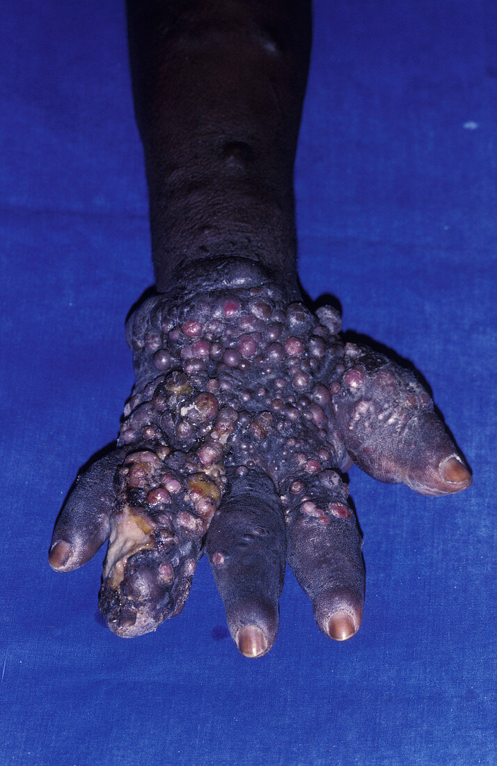 Kaposi's sarcoma of the hand