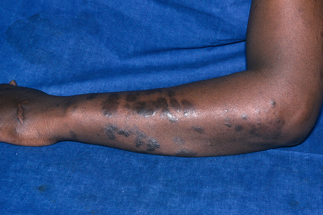 Kaposi's sarcoma skin plaques