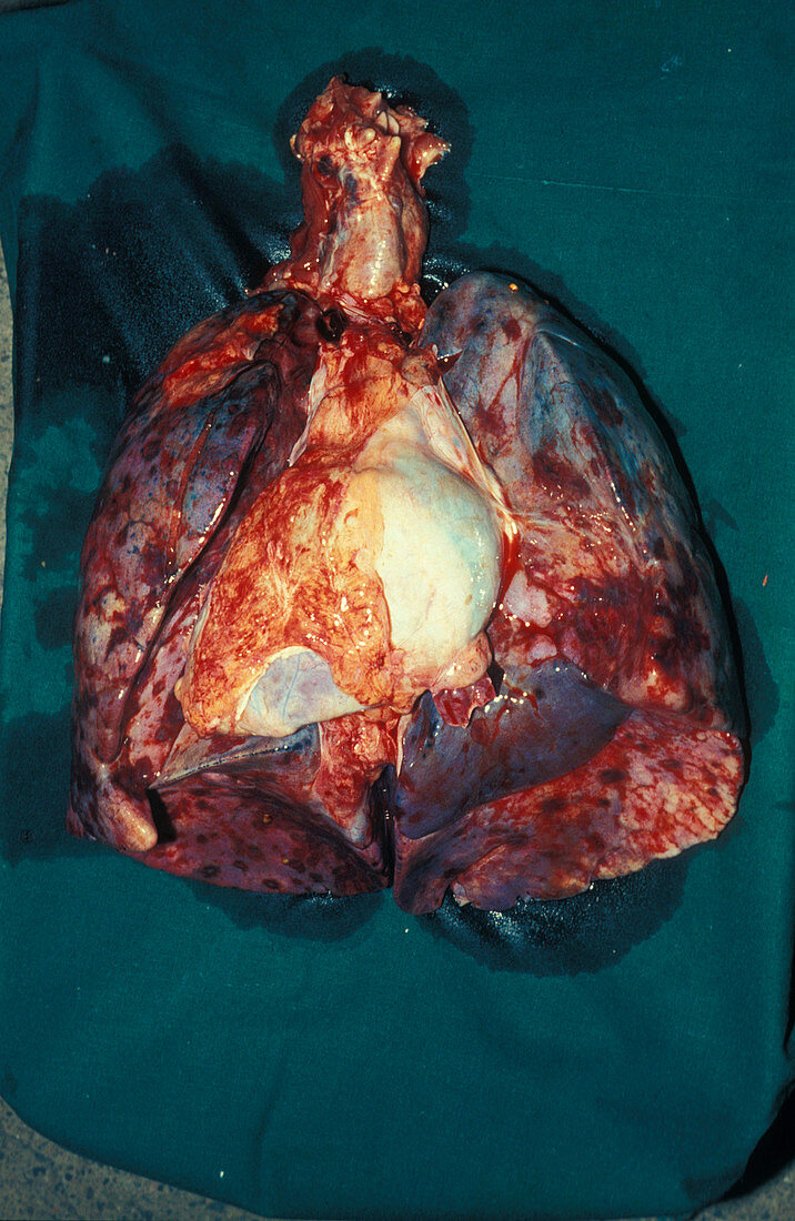 Kaposi's sarcoma of the lungs