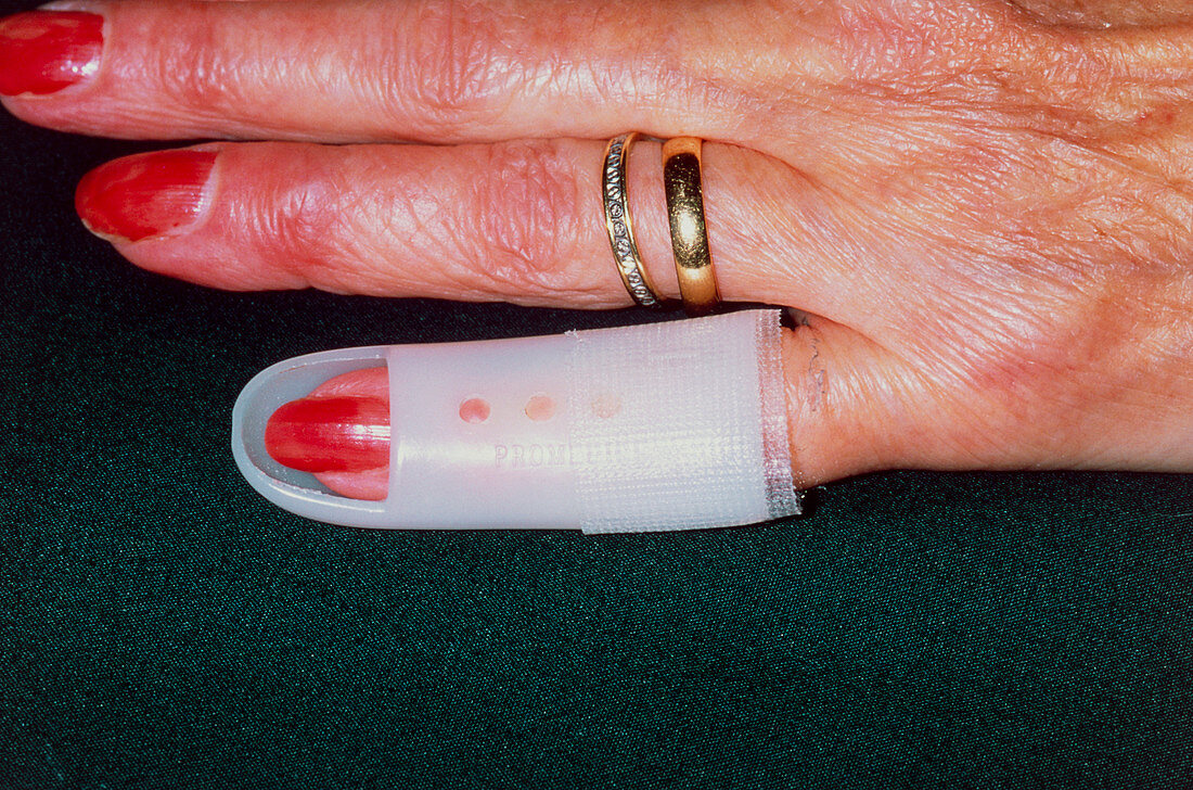 Splint on arthritic finger