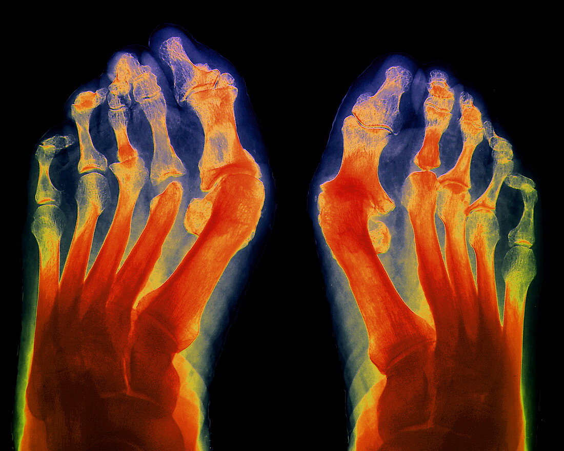 Arthritic feet,X-ray