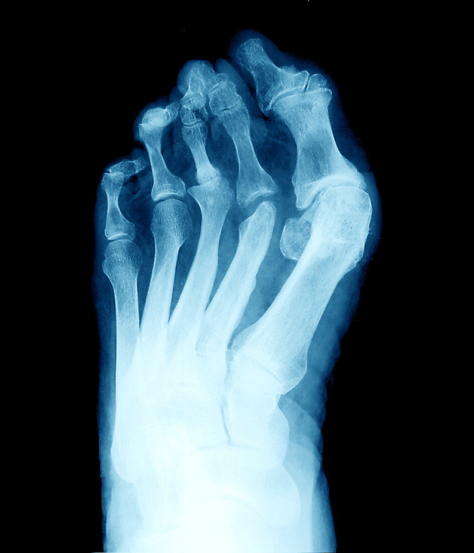 Arthritic foot,X-ray