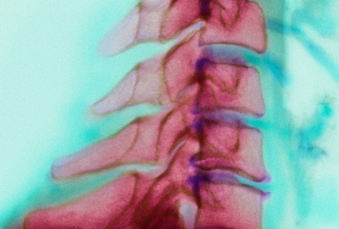 Bony spurs in neck,X-ray