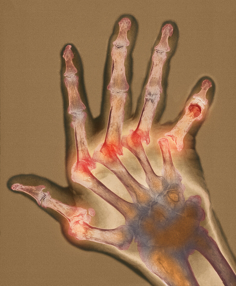 Arthritic hand,X-ray