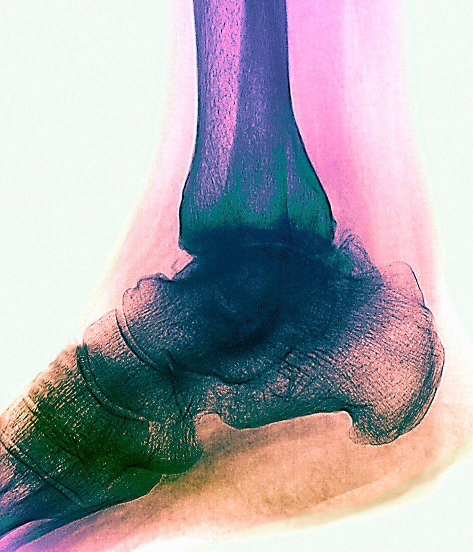 Arthritic ankle,X-ray