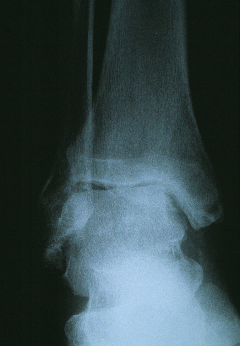 Osteoarthritis of the ankle,X-ray