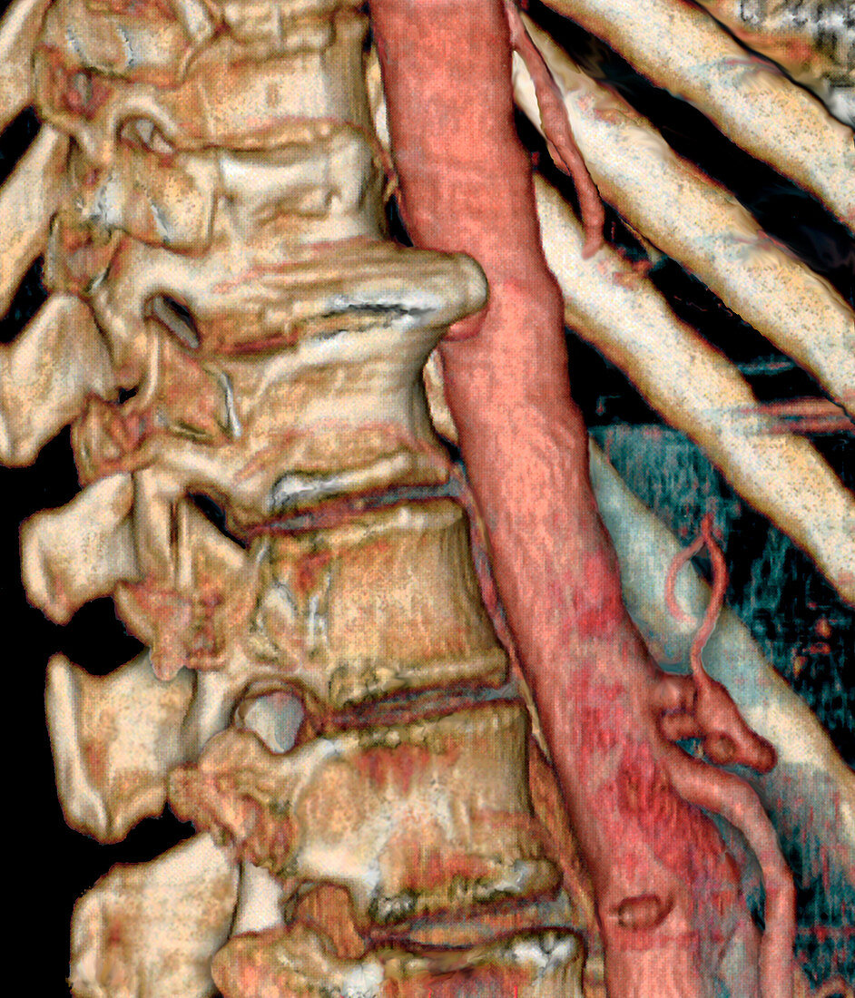 Joint disease of spine,CT scan