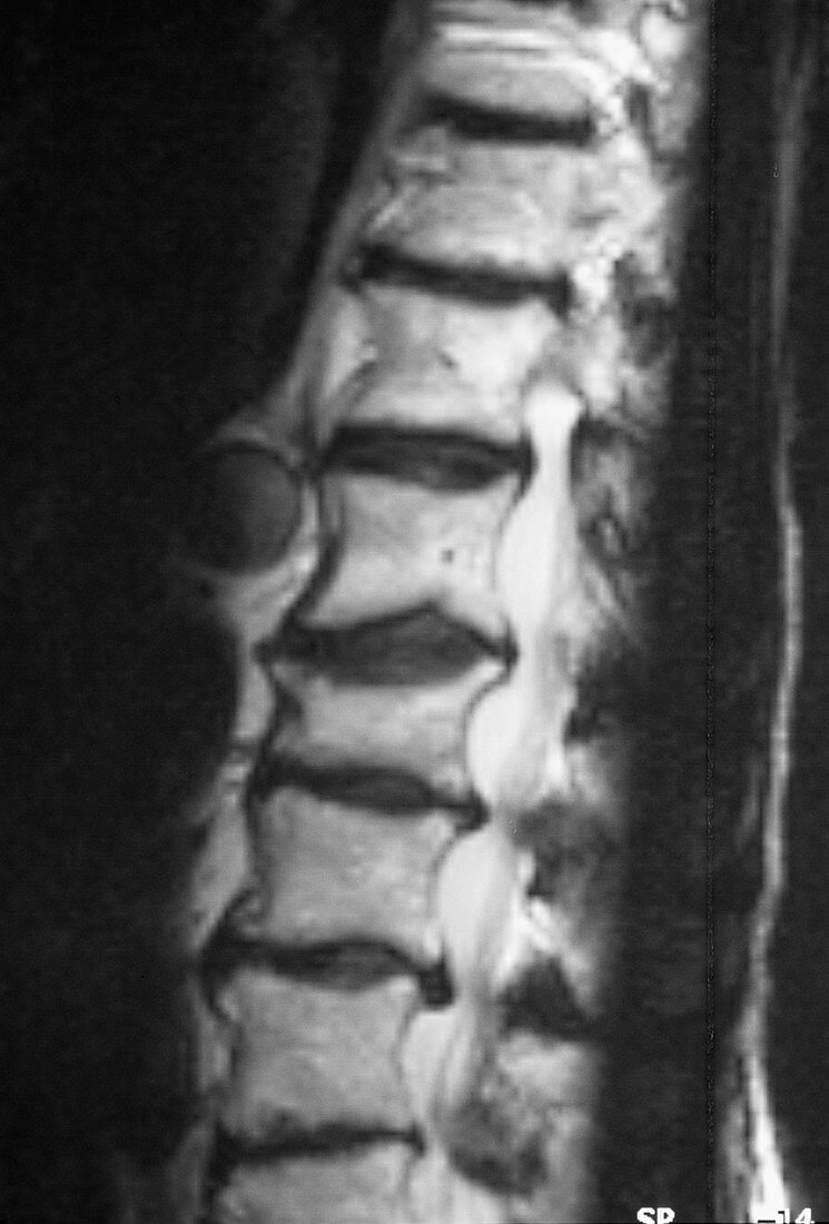 Osteoarthritis of the spine,MRI