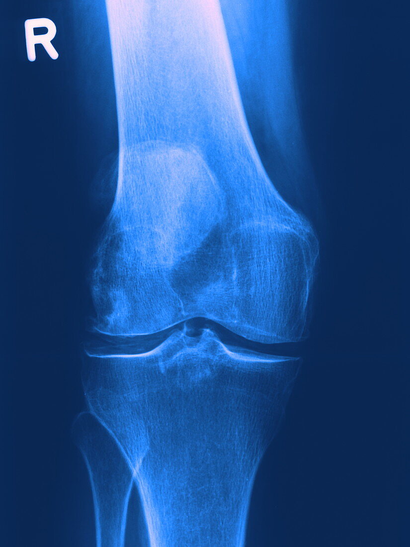 Arthritic knee