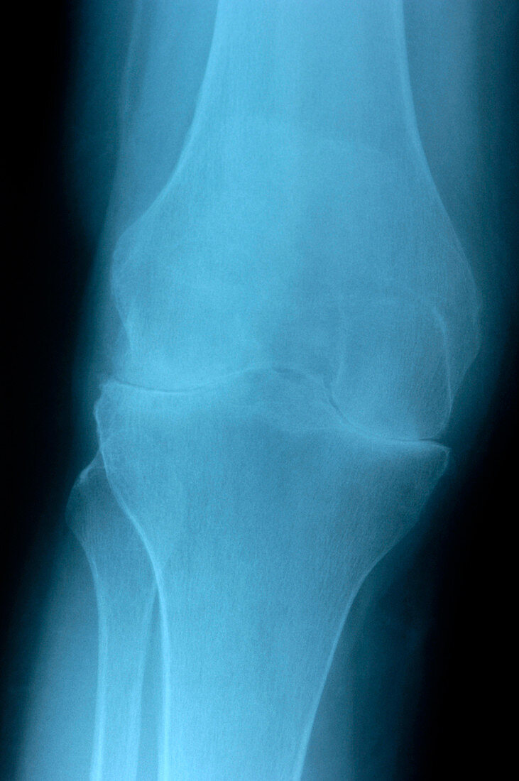 Arthritic knee,X-ray
