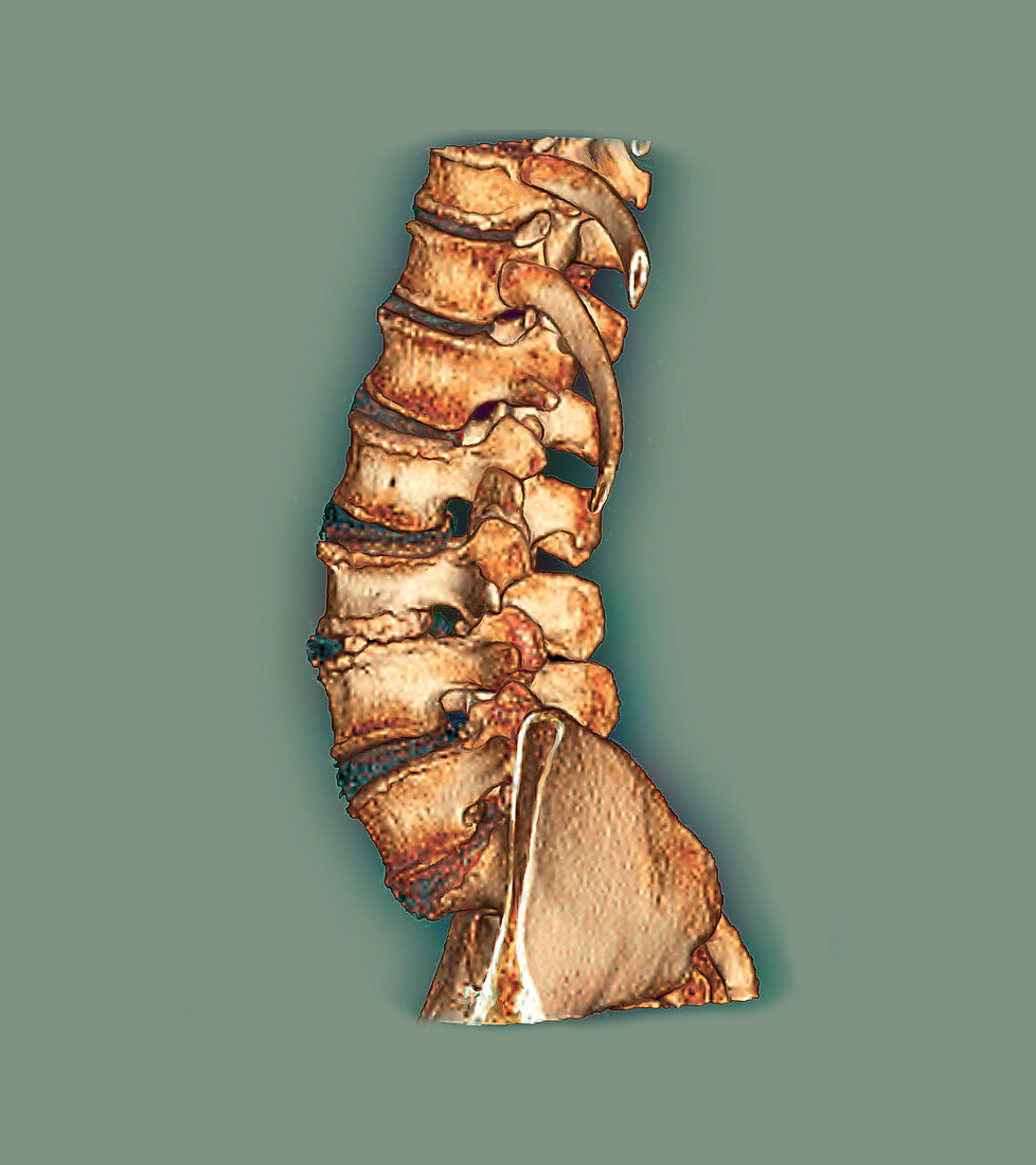 Arthritis of the spine,CT scan