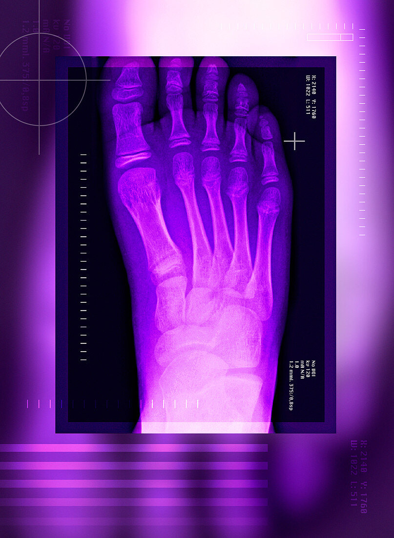 Bunion after surgery,X-ray