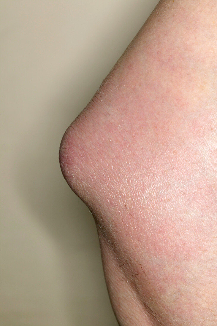 Bursitis of the elbow