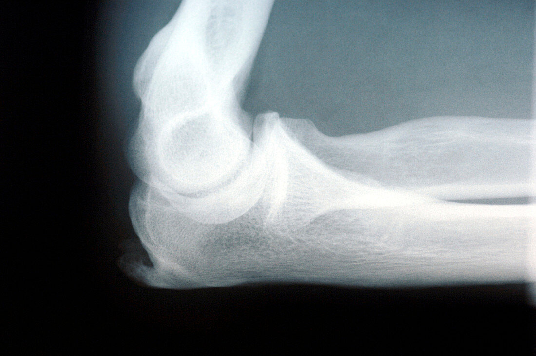 Bursitis of the elbow,X-ray