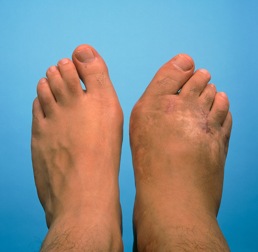 Bunion on a man's foot