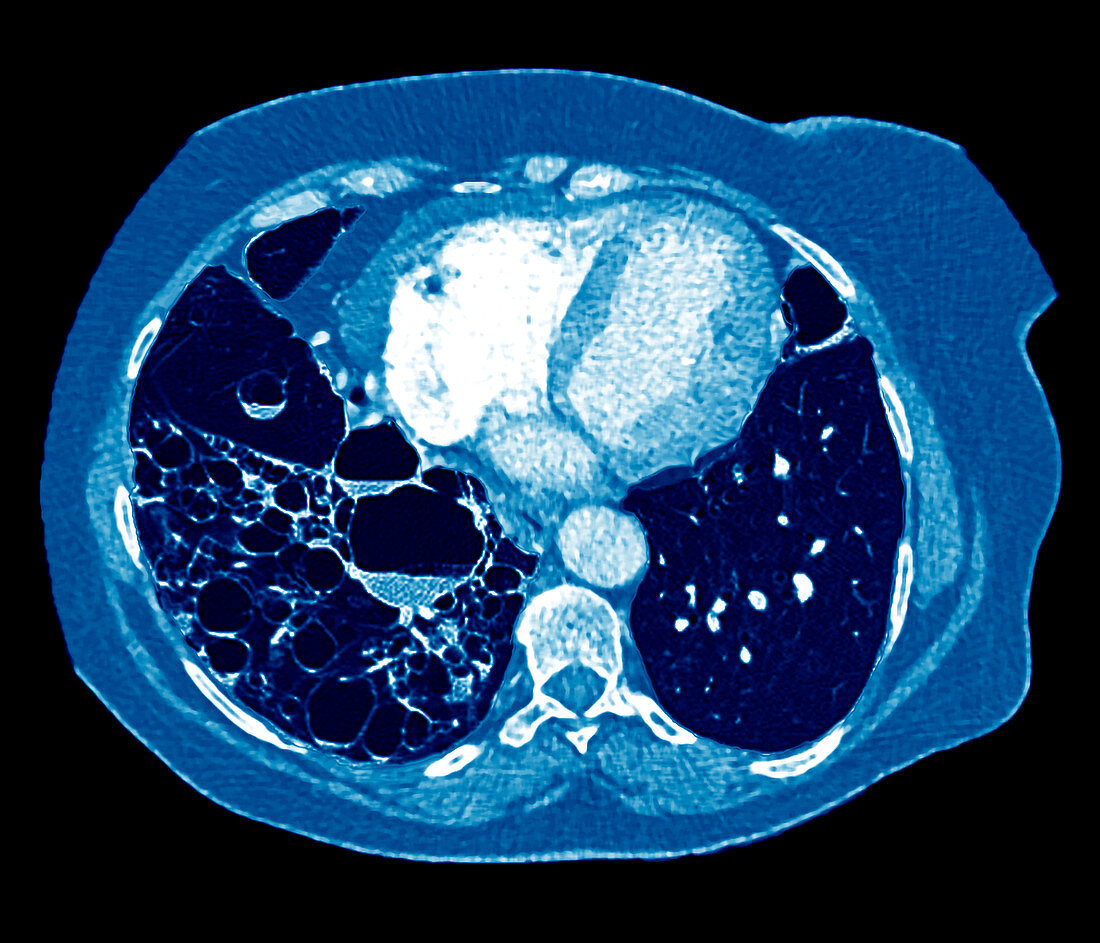 Bronchiectasis,CT scan