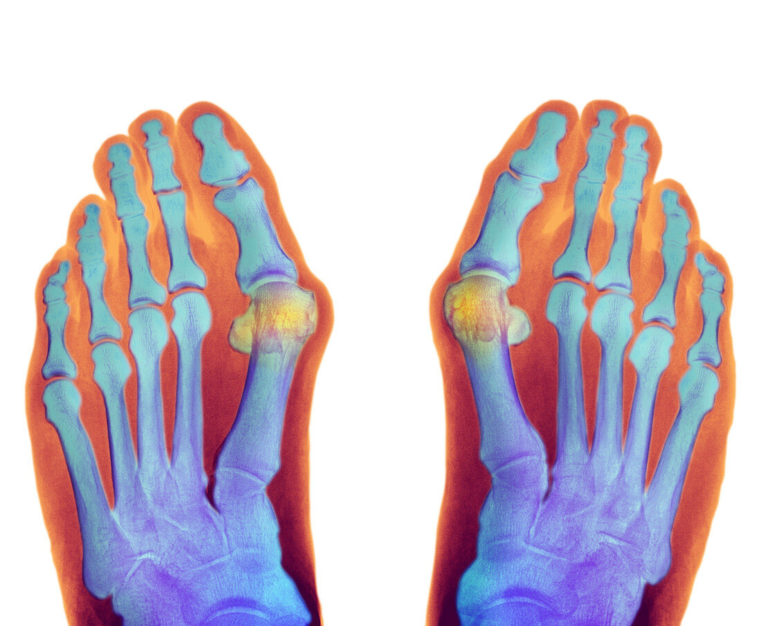 Bunions,X-ray