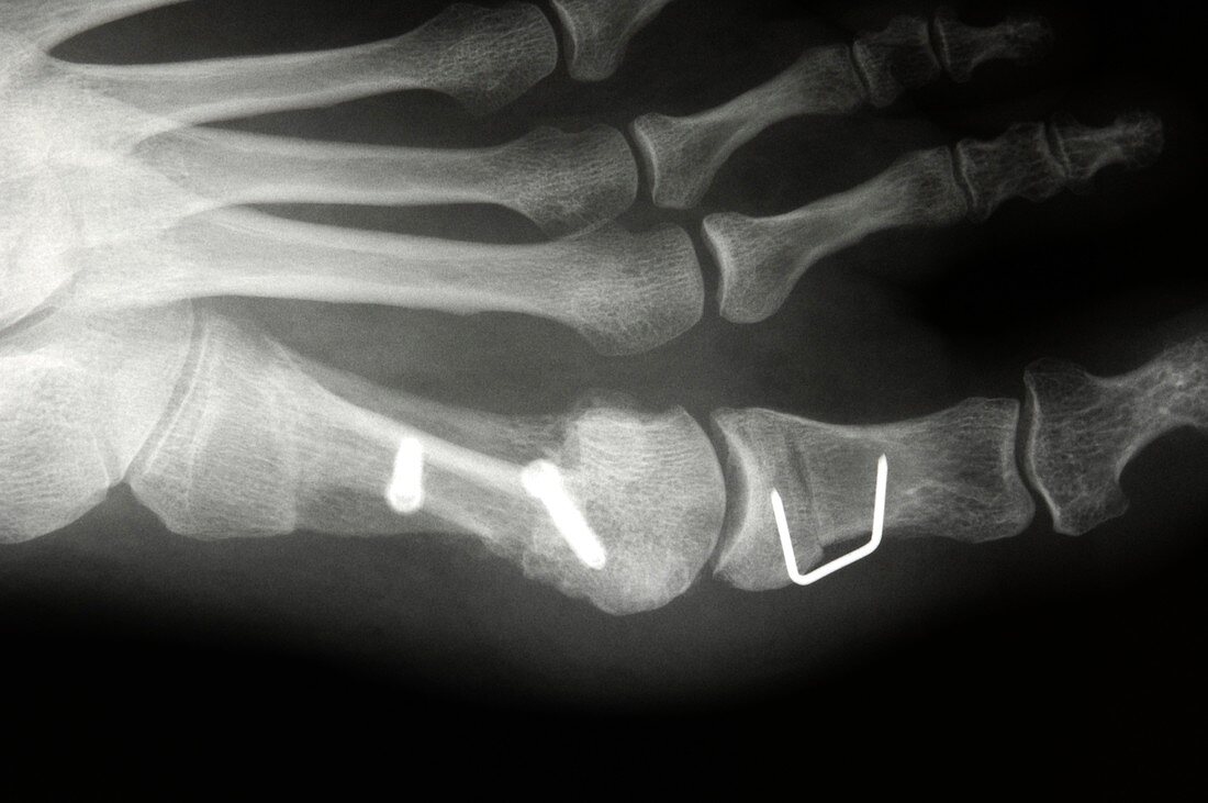 Bunion treatment,X-ray