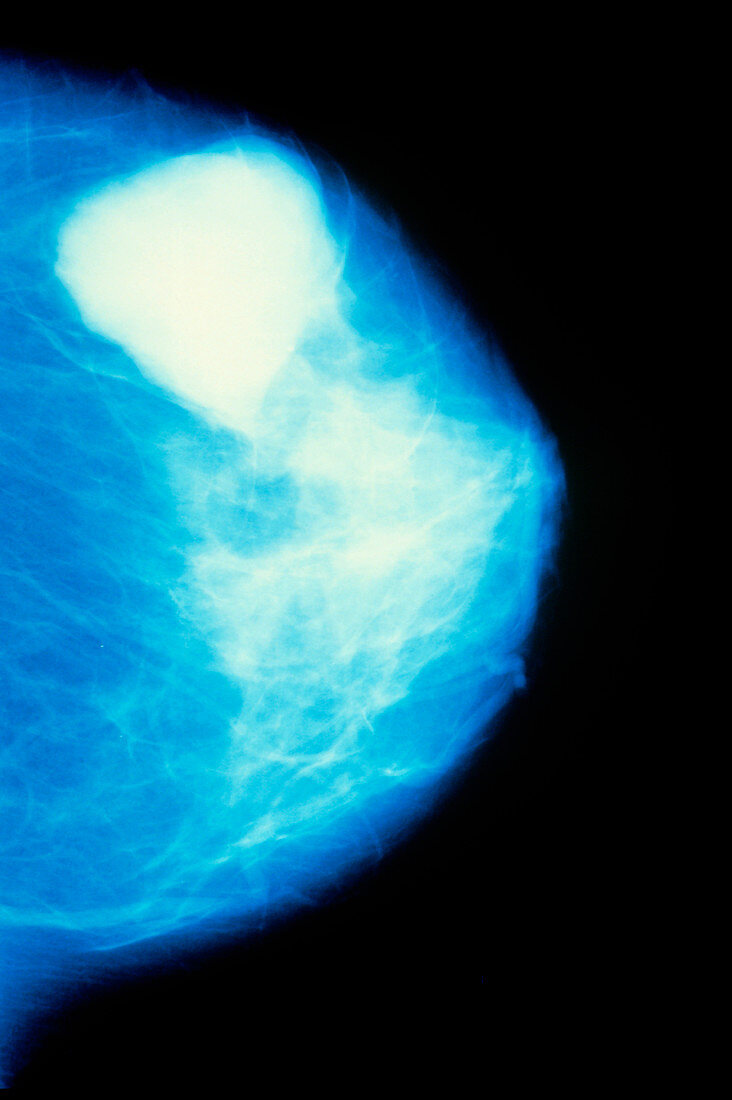 Mammogram of female breast showing fibroadenoma