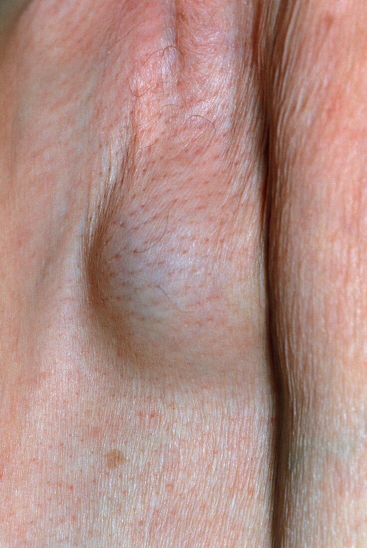 Carcinoma (breast cancer) in a woman's armpit