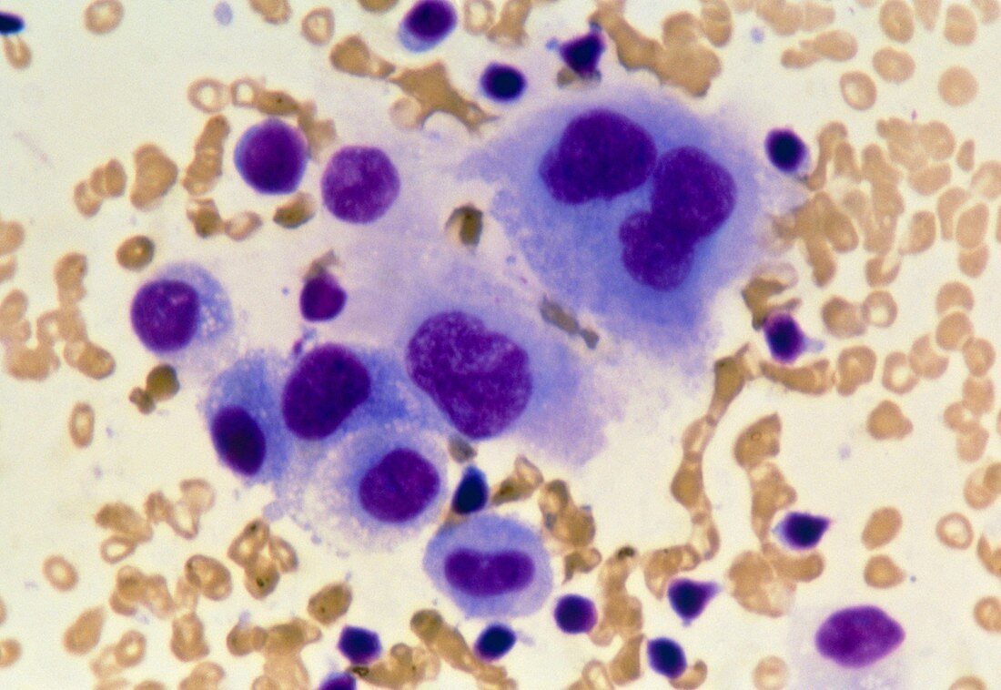 LM of malignant cancer cells from breast duct