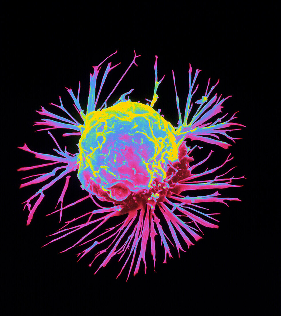 Coloured SEM of a breast cancer cell