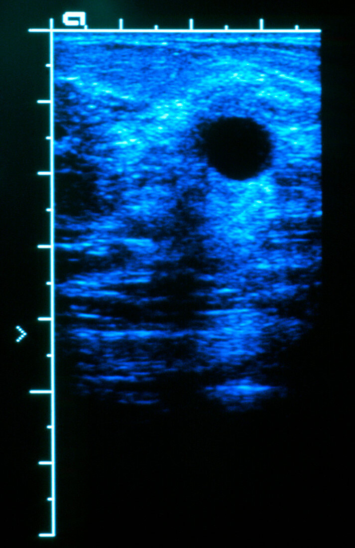 Breast cyst ultrasound