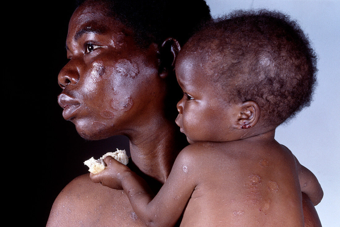 AIDS baby with mother
