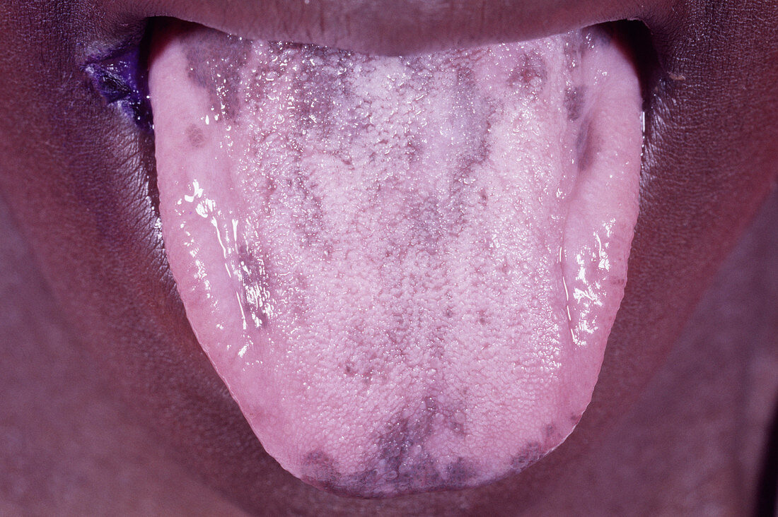 AIDS woman with a hairy tongue